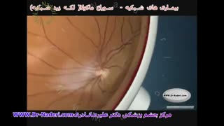 سوراخ ماکولا ی شبکیه - مرکزچشم پزشکی دکتر علیرضا نادری