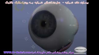 عمل اسکلرال باکل شبکیه -مرکزچشم پزشکی دکتر علیرضا نادری
