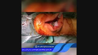 تعویض مفصل زانو