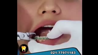 بازکردن براکت های ارتودنسی
