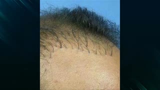 کاشت مو | فیلم کاشت مو | کلینیک پوست و مو رز | شماره 31