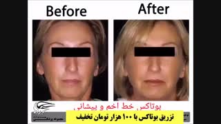 تاثیر تزریق بوتاکس بر خطوط اخم و پیشانی