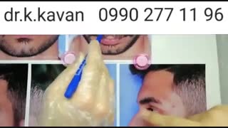 عمل جراحی بینی توسط دکتر کاوان