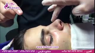 رفع گرفتگی و عمل زیبایی بینی توسط دکتر کاوان