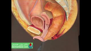 درمان فیستول با لیزر توسط دکتر بیژن عابدیان