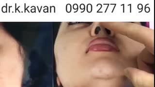 جراحی بینی فانتزی و نیمه فانتزی توسط دکتر کاوان