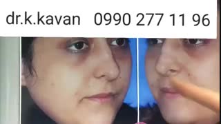 عمل بینی استخوانی و گوشتی توسط دکتر کاوان