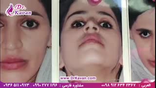 عمل زیبایی بینی