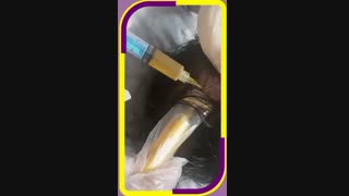 تزریقPRP