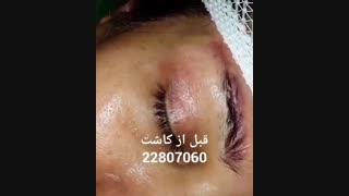 کاشت ابرو - دکتر ابدالی - 22807060