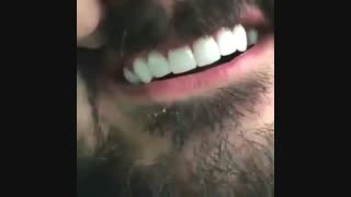 قبل وبعد تجمیل الاسنان | اسعار ابتسامة هولیود | ابتسامة هولیود فی ایران