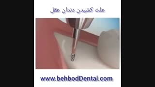 چرا باید دندان عقل را بکشیم؟!؟