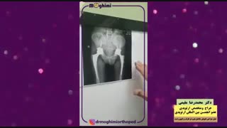 فیلم جراحی تعویض مفاصل لگن