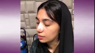 فیلم نحوه چسب زدن بینی بعد از جراحی