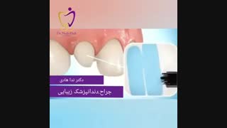 نحوه انجام کامپوزیت دندان