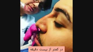 فیلم برداشتن قوز بینی بدون جراحی