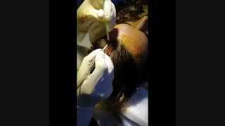 کاشت مو طبیعی | کلینیک لیان | 02188978829