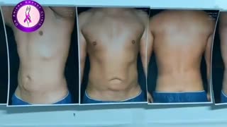 جراحی کامل شکم و پهلوها در آقای 38 ساله