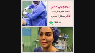 تزریق چربی به باسن