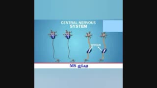 بیماری ام اس را بهتر بشناسیم