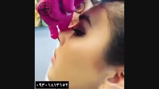 اصلاح فرم بینی بدون عمل جراحی