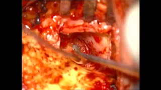 ترمیم پارگی پرده صماخ