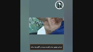 جراحی تومور جدار قفسه سینه