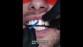 فیلم لمینت دندان ها در کلینیک دندانپزشکی