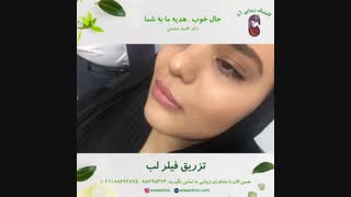 تزریق فیلر لب - کلینیک زیبایی آنا
