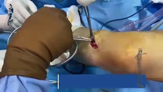 فیلم عمل جراحی رباط صلیبی زانو