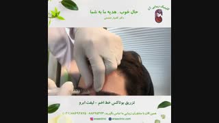 بوتاکس خط اخم - لیفت ابرو - کلینیک زیبایی آنا