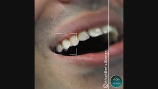 روکش زیرکونیوم