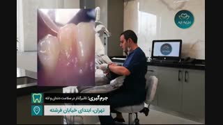 جرمگیری و برداشتن پلاک های تشکیل شده روی دندان