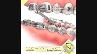 دستگاه فانکشنال ثابت | دکتر لادن طیبی