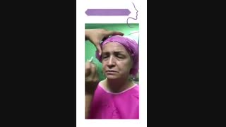 جراحی پلک افتاده در تهران