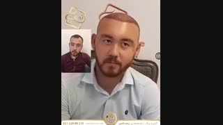 تکنیک سوپر کاشت کلینیک رنسانس- 02122088210