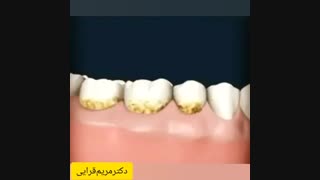 جرمگیری باعث لق شدن دندان می شود؟