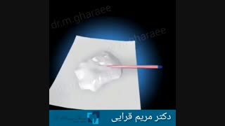 عصب کشی و روکش دندان