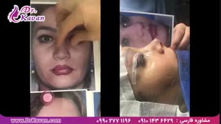 عمل زیبایی بینی و پلک