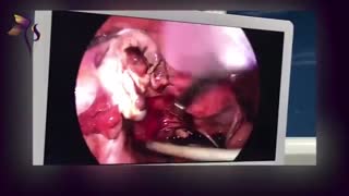 لاپاراسکوپی کیست تخمدان