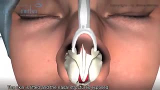 جراحی رینوپلاستی