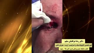 جراحی تومور بدخیم