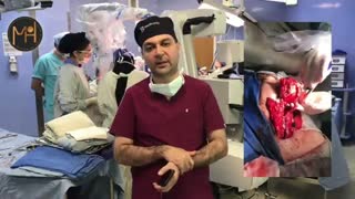 انتقال فری فلپ از ران به صورت در جراحی پاروتید