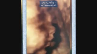 سونوگرافی چهاربعدی جنین پسر