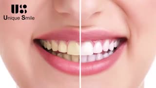 اصلاح رنگ دندان | دکتر لیلا عطایی