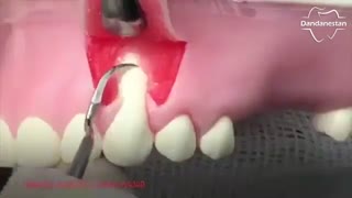 جراحی لثه | دندانستان ماموپلاستی