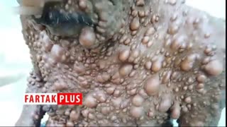 مردی با یک بیماری پوستی نادر لیزر صورت